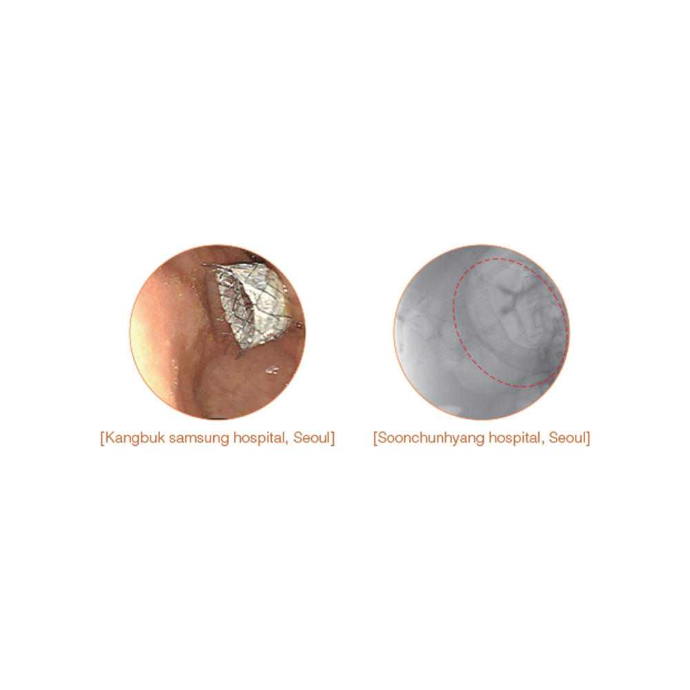ComVi Enteral Colonic Stent [Both Bare-Type]