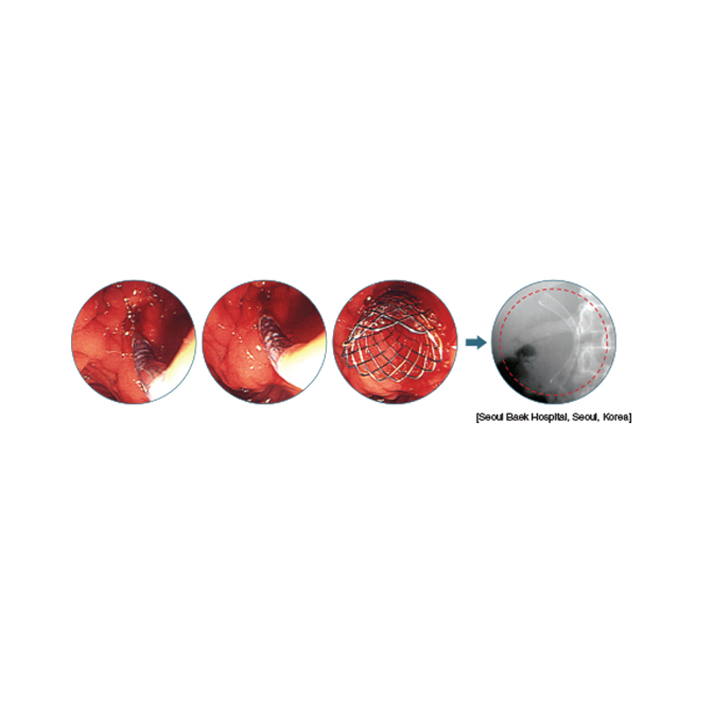 Niti-S Biliary Uncovered Stent [S-Type]