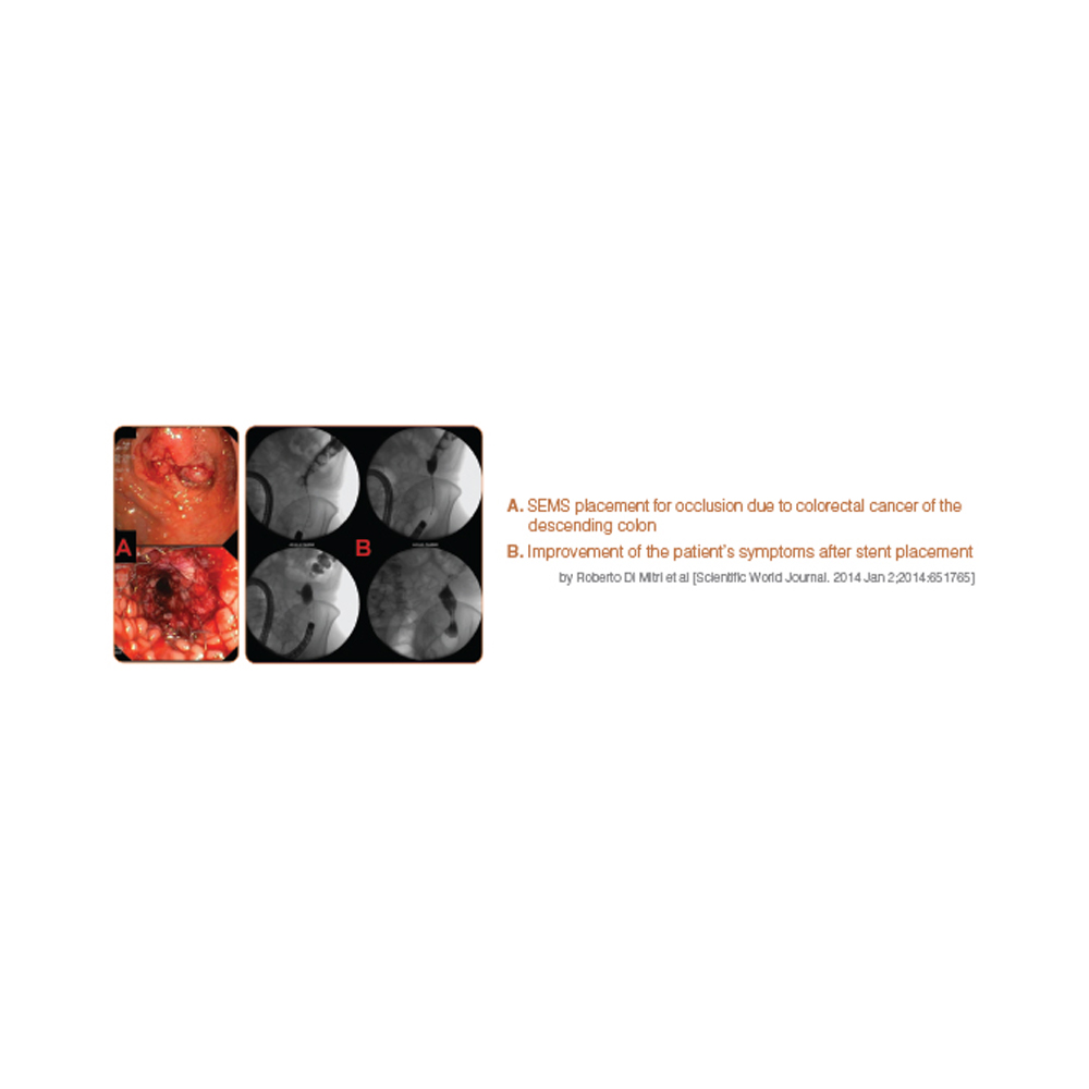 Niti-S Enteral Colonic Uncovered Stent [D-Type]